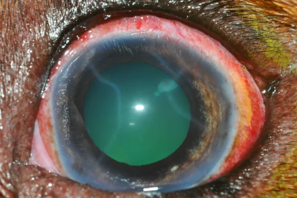 Glaucoma Patologie oculari - Glaucoma