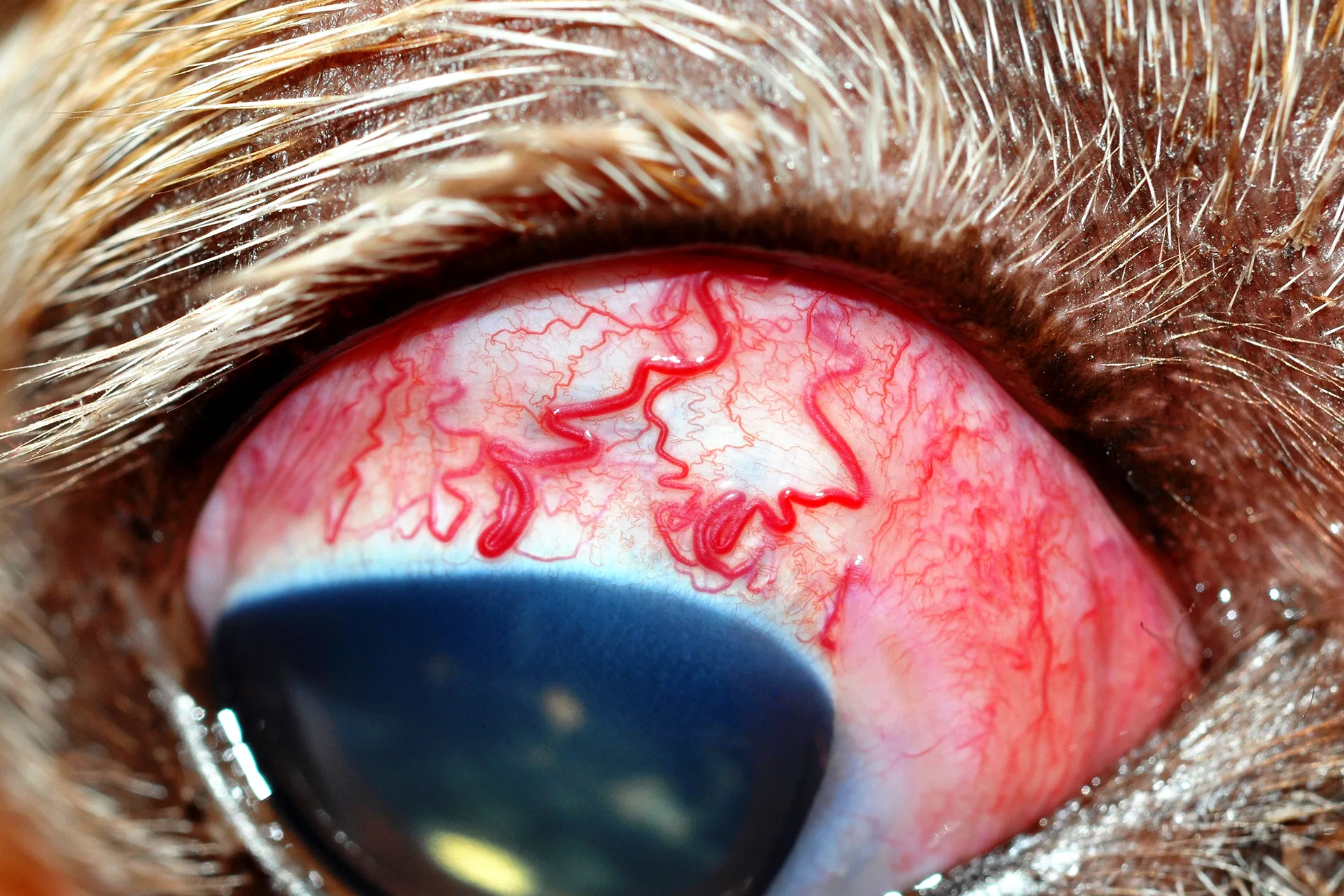Glaucoma