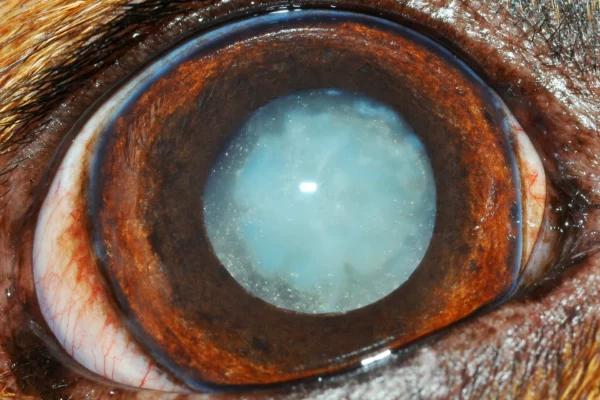 Cataratta di Morgagni Patologie oculari - Cataratta di Morgagni