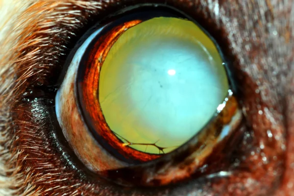 Cataratta immatura associata a PPM Patologie oculari - Cataratta immatura associata a PPM