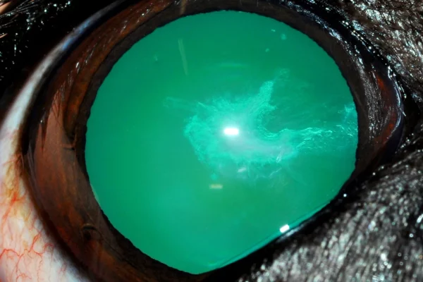 Cataratta sottocapsulare anteriore focale Patologie oculari - Cataratta sottocapsulare anteriore focale